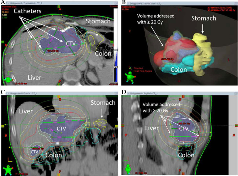 Combined CT-guided high-dose-rate brachytherapy (CT-HDRBT) and transarterial chemoembolization with irinotecan-loaded microspheres improve local tumor control and progression-free survival in patients with unresectable colorectal liver metastases compared with mono-CT-HDRBT.