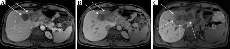 Combined CT-guided high-dose-rate brachytherapy (CT-HDRBT) and transarterial chemoembolization with irinotecan-loaded microspheres improve local tumor control and progression-free survival in patients with unresectable colorectal liver metastases compared with mono-CT-HDRBT.