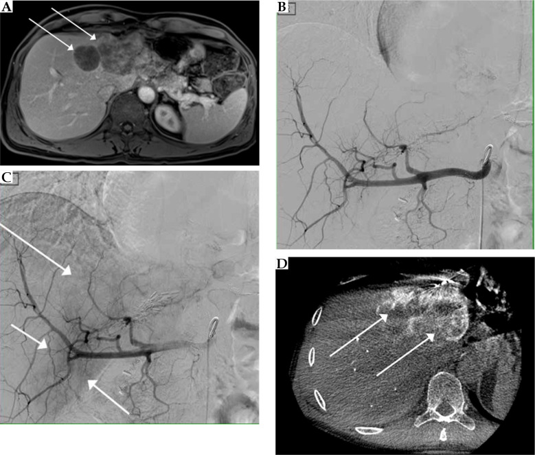 Combined CT-guided high-dose-rate brachytherapy (CT-HDRBT) and transarterial chemoembolization with irinotecan-loaded microspheres improve local tumor control and progression-free survival in patients with unresectable colorectal liver metastases compared with mono-CT-HDRBT.