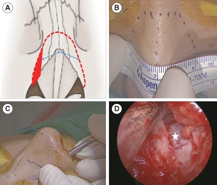 One-Unit Osteotomy to Correct Deviated Bony Dorsum.