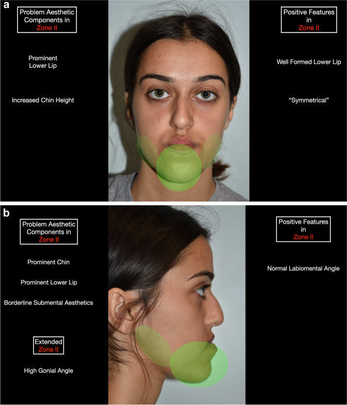 Zonal analysis in contemporary aesthetic orthognathic surgical planning.