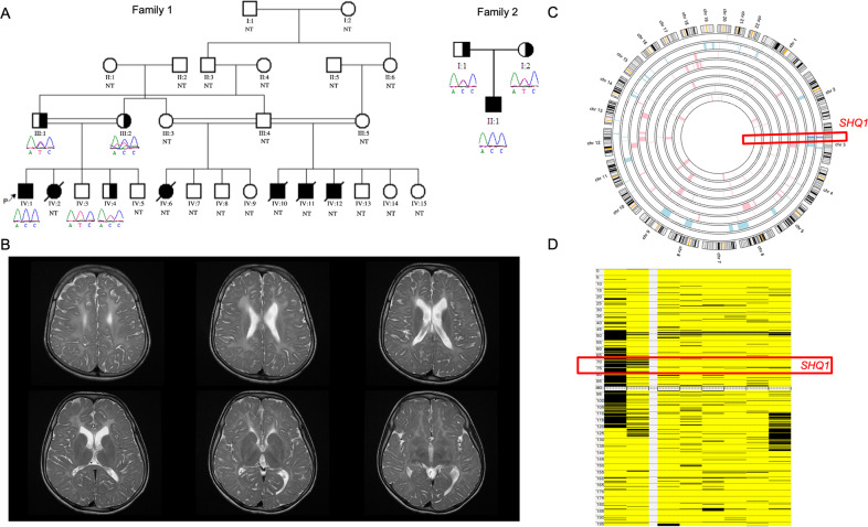 SHQ1-associated neurodevelopmental disorder: Report of the first homozygous variant in unrelated patients and review of the literature.