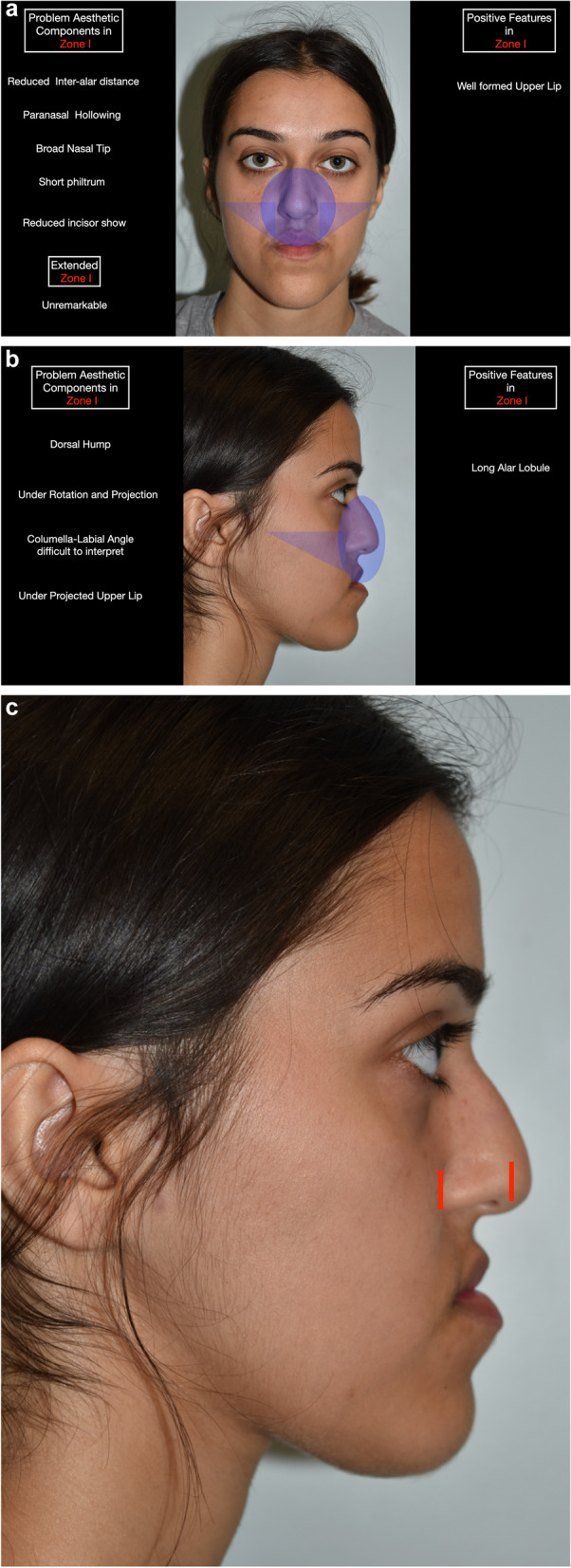 Zonal analysis in contemporary aesthetic orthognathic surgical planning.