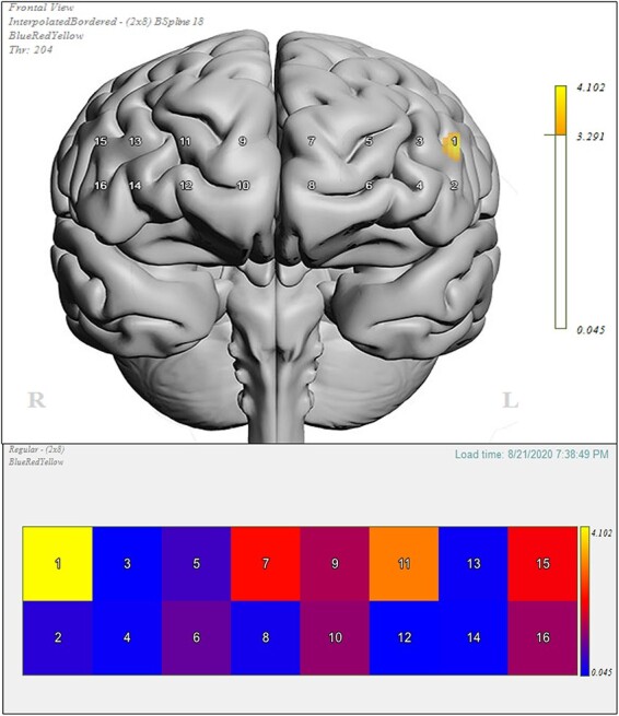 Effects of prefrontal theta burst stimulation on neuronal activity and subsequent eating behavior: an interleaved rTMS and fNIRS study.