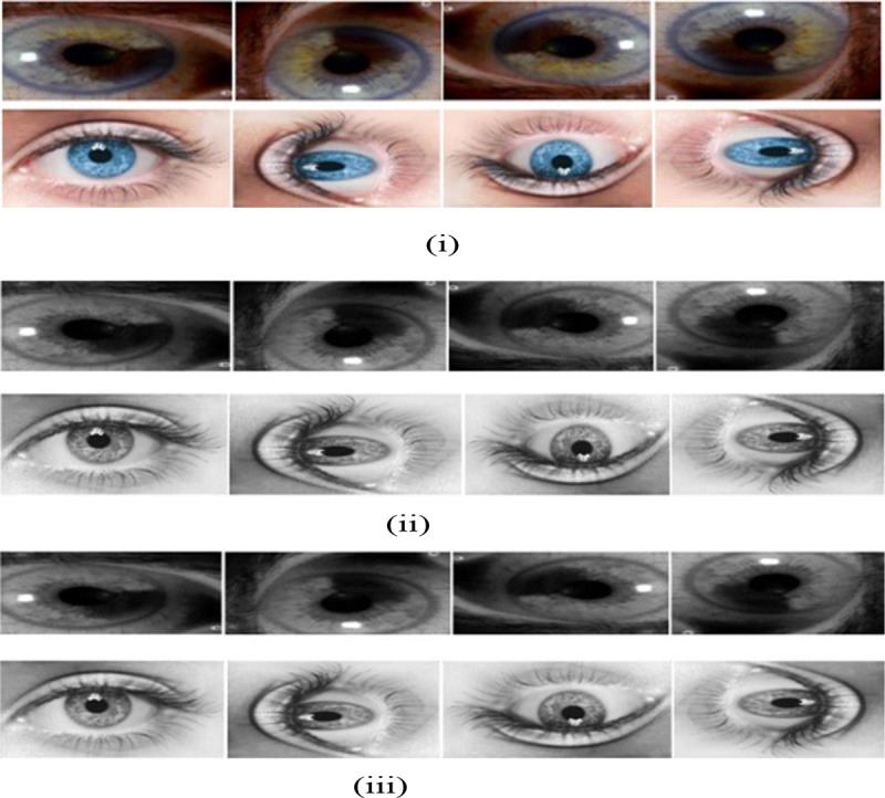 Eye Melanoma Diagnosis System using Statistical Texture Feature Extraction and Soft Computing Techniques.