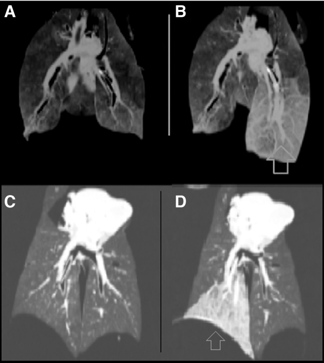 Positron Emission Tomography-Computed Tomography Imaging of Selective Lobar Delivery of Stem Cells in <i>Ex Vivo</i> Lung Model of Mechanical Ventilation.