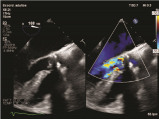 Streptococcus cristatus, an infrequent cause of bacteremia and infective endocarditis. Case report and literature review.