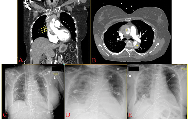 Stanford Type A Aortic Dissection in A Patient with Primary Antiphospholipid Syndrome and Coronavirus Disease 2019.