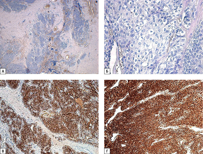 [Casuistic cases of parathyroid carcinoma with a verified mutation in the <i>MEN1</i> gene].