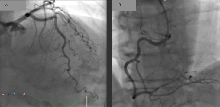 Role of cardiac magnetic resonance in MINOCA of unclear etiology: a case report of a suspicious paradoxical coronary embolism.