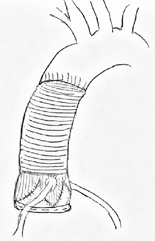 Aortic Root Surgery in Adults: An Unsolved Problem.