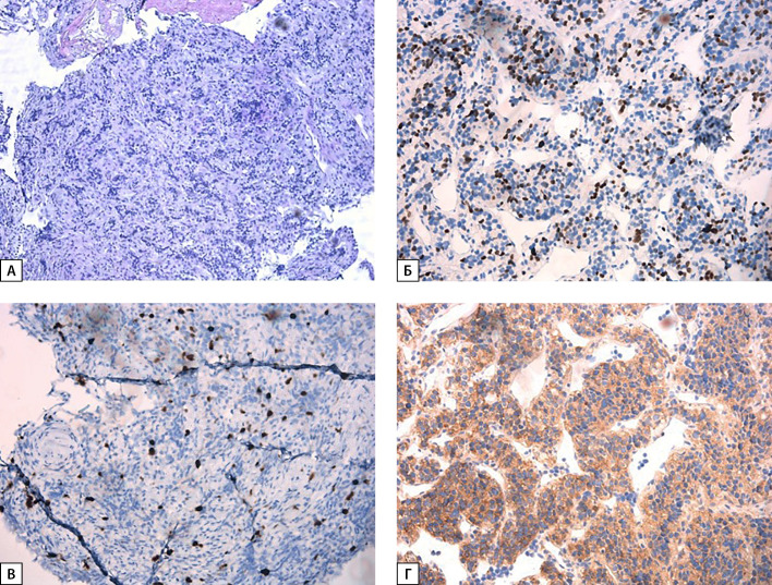 [Casuistic cases of parathyroid carcinoma with a verified mutation in the <i>MEN1</i> gene].