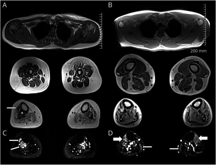 Novel Homozygous Variant in <i>COQ7</i> in Siblings With Hereditary Motor Neuropathy.