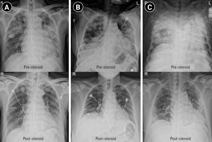 Methylprednisolone pulse therapy for critically ill patients with COVID-19: a cohort study.