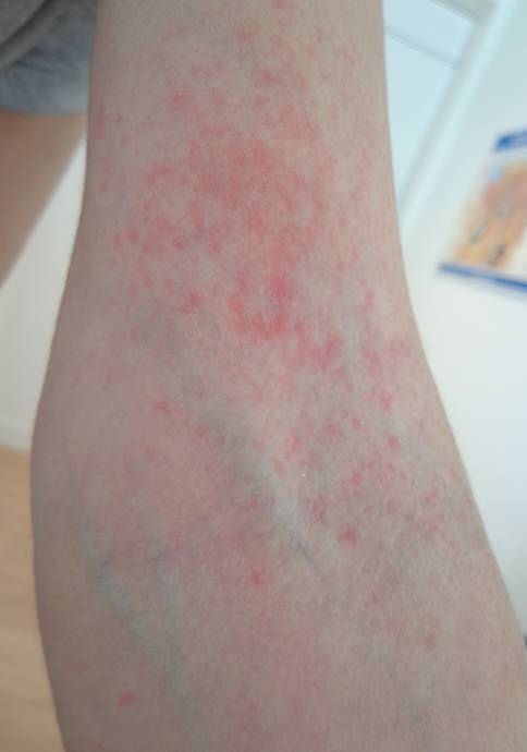 Coronavirus infection in an unvaccinated atopic dermatitis patient under ongoing dupilumab therapy: eczema flare-up, but moderate COVID-19 symptoms