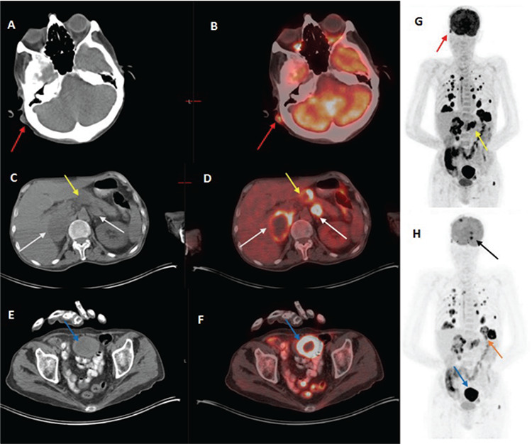 A Rare Case and Atypical Metastatic Regions, Pulmonary Giant Cell Carcinoma.