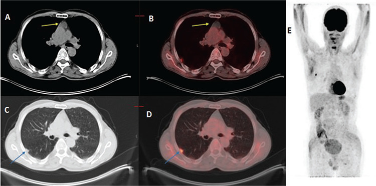 A Rare Case and Atypical Metastatic Regions, Pulmonary Giant Cell Carcinoma.