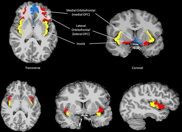 Morphometry of the lateral orbitofrontal cortex is associated with eating dispositions in early adolescence: findings from a large population-based study.