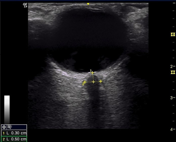 Ultrasonographic measurement of the optic nerve sheath diameter to detect intracranial hypertension: an observational study.