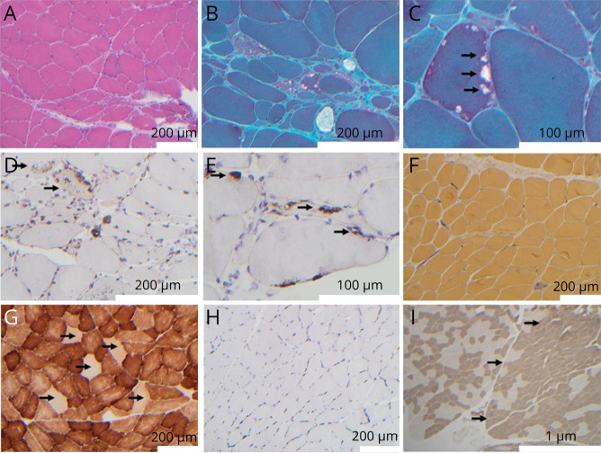 Prevalence of Frontotemporal Dementia in Females of 5 Hispanic Families With R159H VCP Multisystem Proteinopathy.