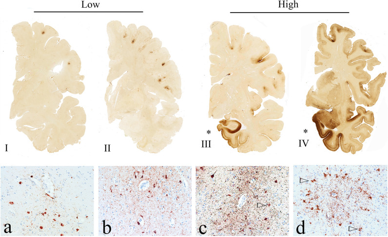 Chronic traumatic encephalopathy (CTE): criteria for neuropathological diagnosis and relationship to repetitive head impacts