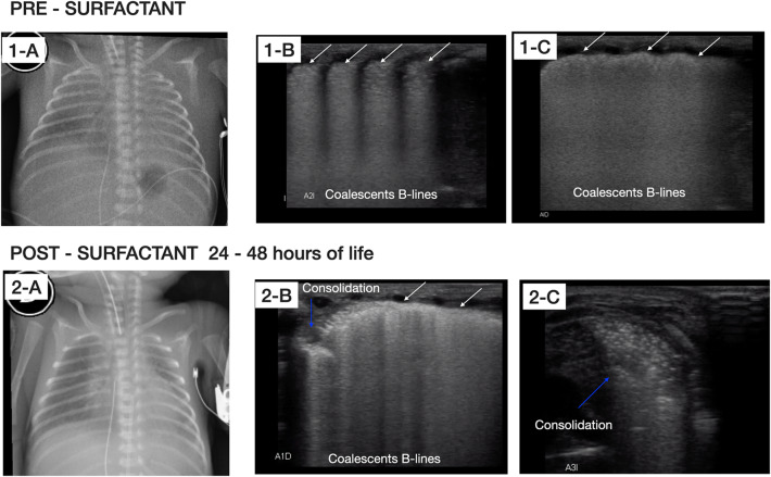 Alveolar capillary dysplasia with misalignment of pulmonary veins in a premature newborn: the role of lung ultrasound.