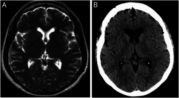 Prevalence of Frontotemporal Dementia in Females of 5 Hispanic Families With R159H VCP Multisystem Proteinopathy.