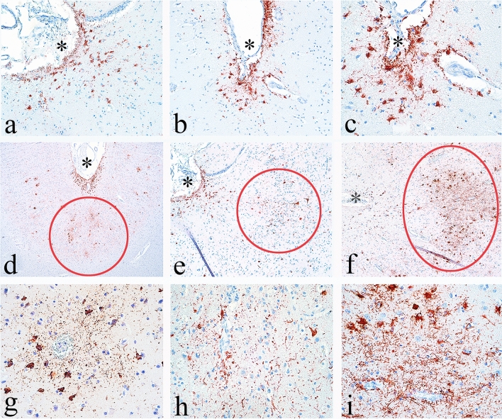 Chronic traumatic encephalopathy (CTE): criteria for neuropathological diagnosis and relationship to repetitive head impacts