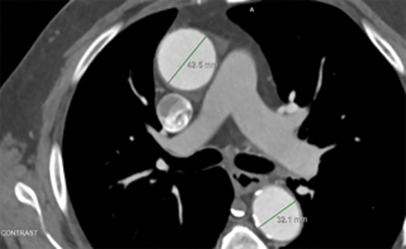 Ascending Aortic Aneurysms <4.5 cm for Nonsyndromic Adults: Very Slow Growth and Low Risk.