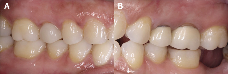 Six-year clinical performance of lithium disilicate glass-ceramic CAD-CAM versus metal-ceramic crowns.