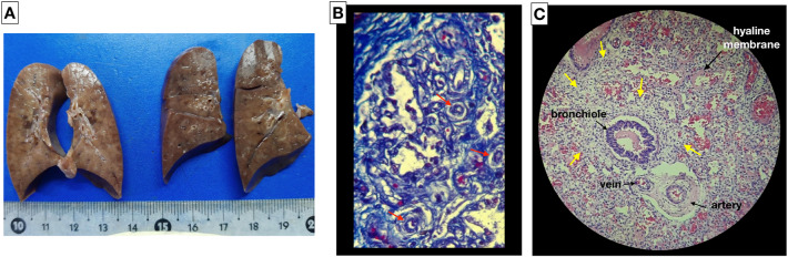 Alveolar capillary dysplasia with misalignment of pulmonary veins in a premature newborn: the role of lung ultrasound.