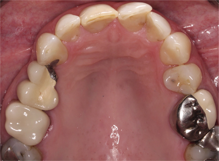 Six-year clinical performance of lithium disilicate glass-ceramic CAD-CAM versus metal-ceramic crowns.