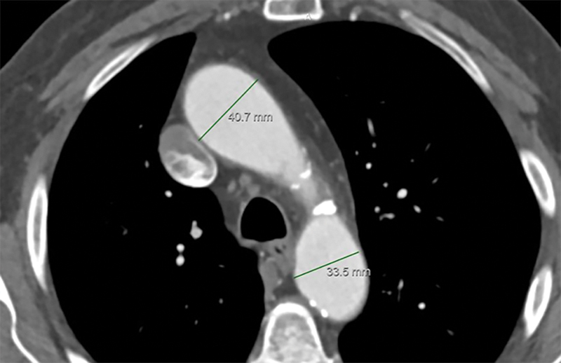 Ascending Aortic Aneurysms <4.5 cm for Nonsyndromic Adults: Very Slow Growth and Low Risk.