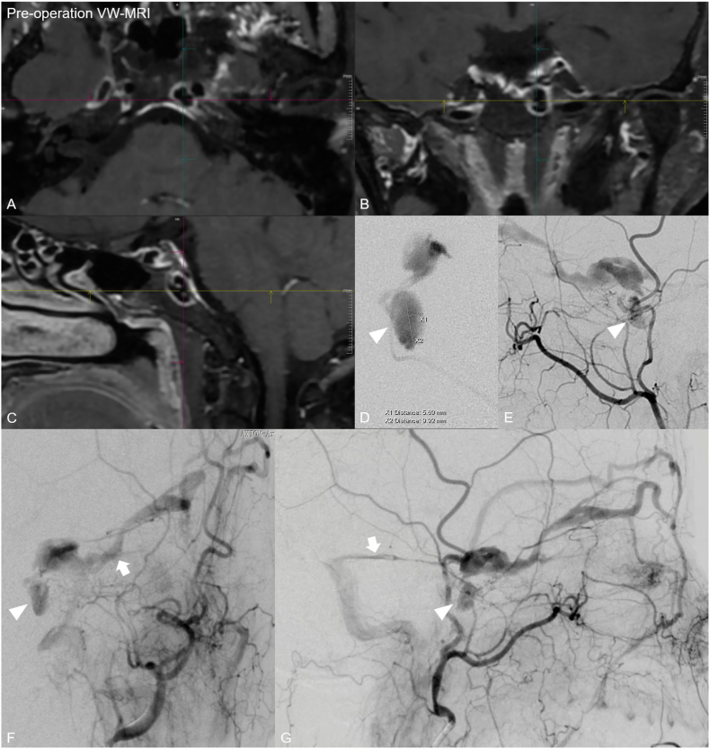 Multimodal MRI diagnosis and transvenous embolization of a basicranial emissary vein dural arteriovenous fistula: A case report