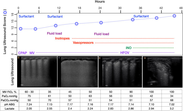 Alveolar capillary dysplasia with misalignment of pulmonary veins in a premature newborn: the role of lung ultrasound.