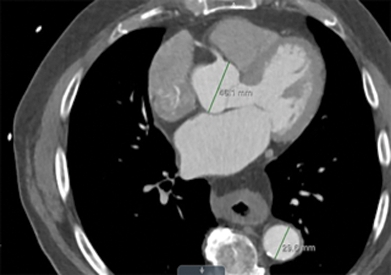 Ascending Aortic Aneurysms <4.5 cm for Nonsyndromic Adults: Very Slow Growth and Low Risk.