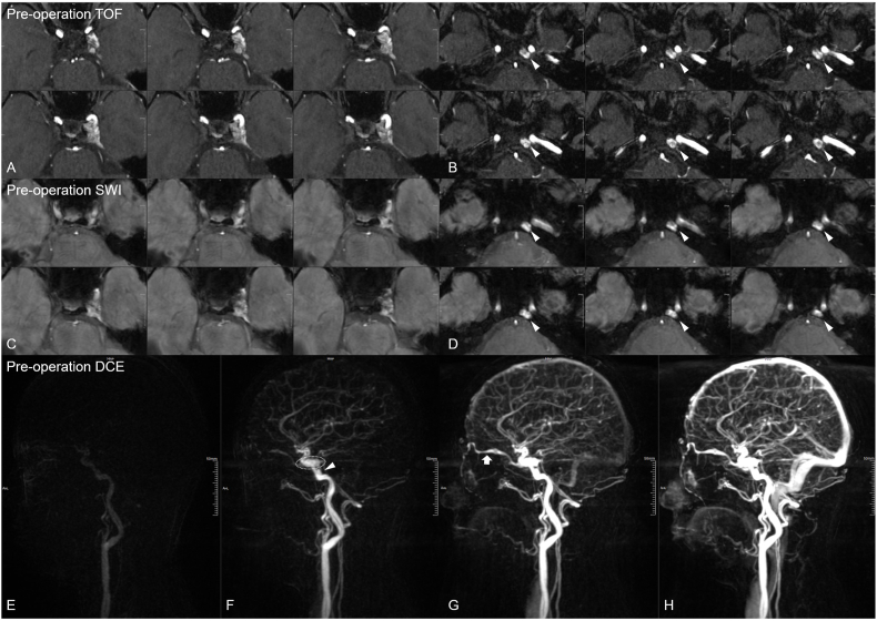 Multimodal MRI diagnosis and transvenous embolization of a basicranial emissary vein dural arteriovenous fistula: A case report