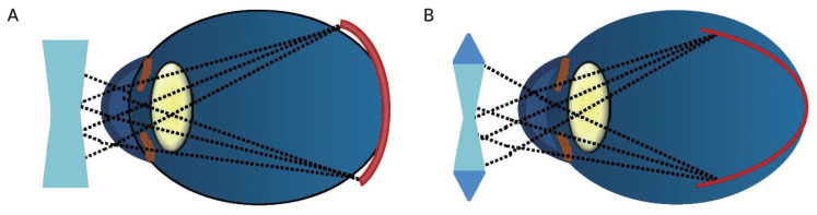 Peripheral Defocus and Myopia Management: A Mini-Review.