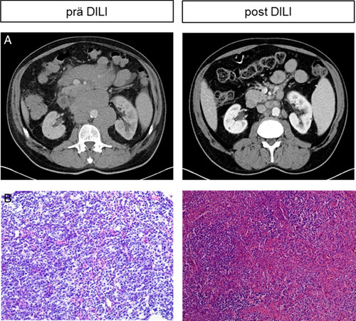 Haploidentical γδ T Cells Induce Complete Remission in Chemorefractory B-cell Non-Hodgkin Lymphoma.