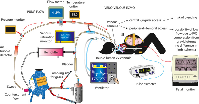 Extracorporeal membrane oxygenation in pregnancy during the SARS-CoV-2 pandemic