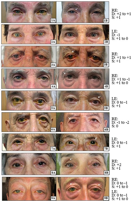 Improvement of Prostaglandin-Associated Periorbitopathy after Discontinuing Treatment.