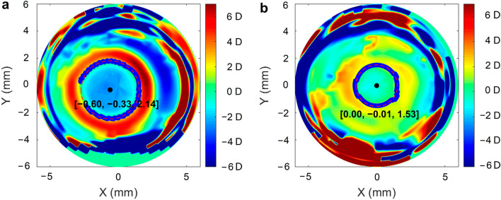 Long-term follow-up of changes in ocular biometric parameters in orthokeratology lens wearers with relatively large-scale axial length reduction.