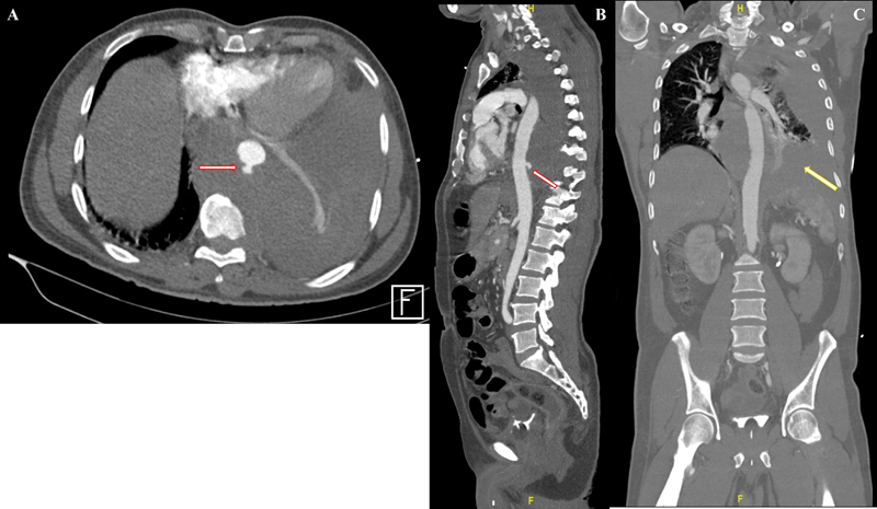 Post-COVID-19 Thoracic Aortic Rupture with an Unforeseen Spinal Epidural Hematoma.