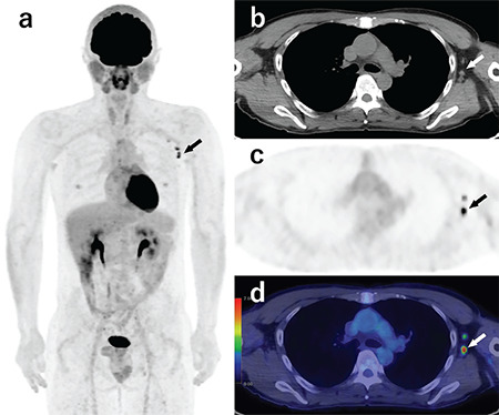 Axillary Lymph Node Uptake on <sup>18</sup>F-FDG PET/CT after COVID-19 Vaccination: A Direct Comparison Study with Influenza Vaccination.