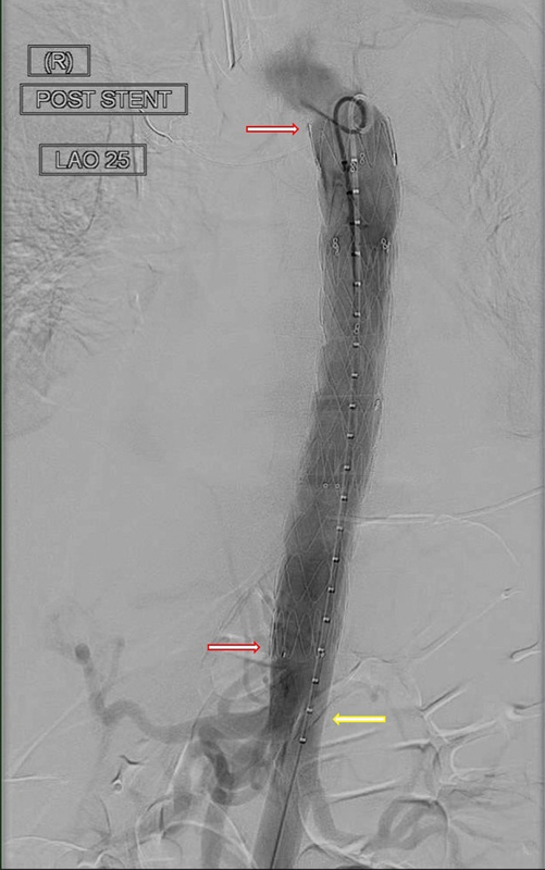 Post-COVID-19 Thoracic Aortic Rupture with an Unforeseen Spinal Epidural Hematoma.