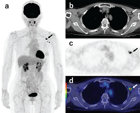 Axillary Lymph Node Uptake on <sup>18</sup>F-FDG PET/CT after COVID-19 Vaccination: A Direct Comparison Study with Influenza Vaccination.