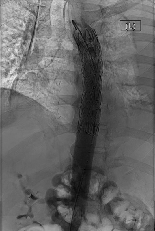 Post-COVID-19 Thoracic Aortic Rupture with an Unforeseen Spinal Epidural Hematoma.