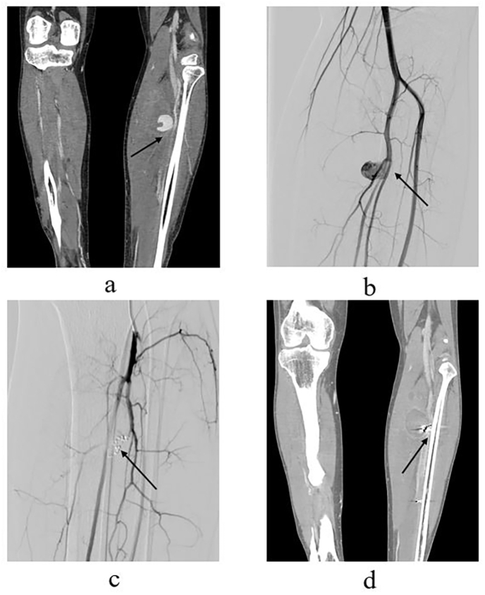 Management of traumatic peripheral artery pseudoaneurysm: A 10-year experience at a single center