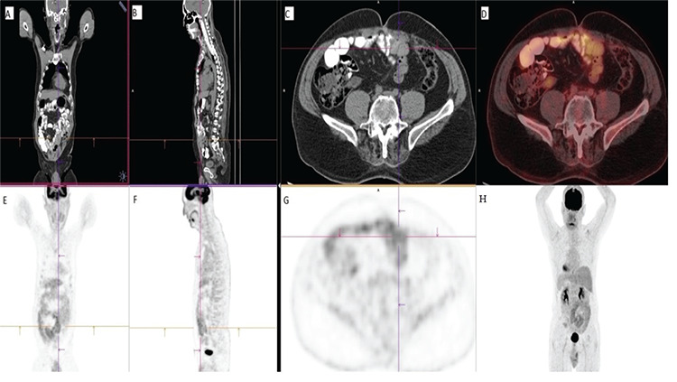 A Rare Hernia Mimicking Implant in a Patient with Rectal Adenocarcinoma: Internal Herniation.