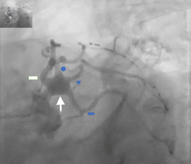 Left Main Coronary Artery Aneurysm With Rare Quadfurcation Anatomy.